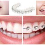 lavado y cuidados de ortodoncia